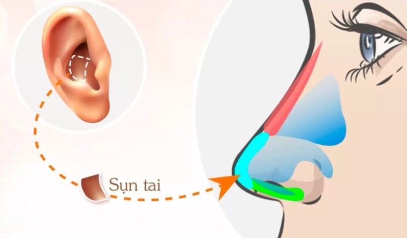 Sụn tai nâng mũi giảm thiểu biến chứng bóng đỏ