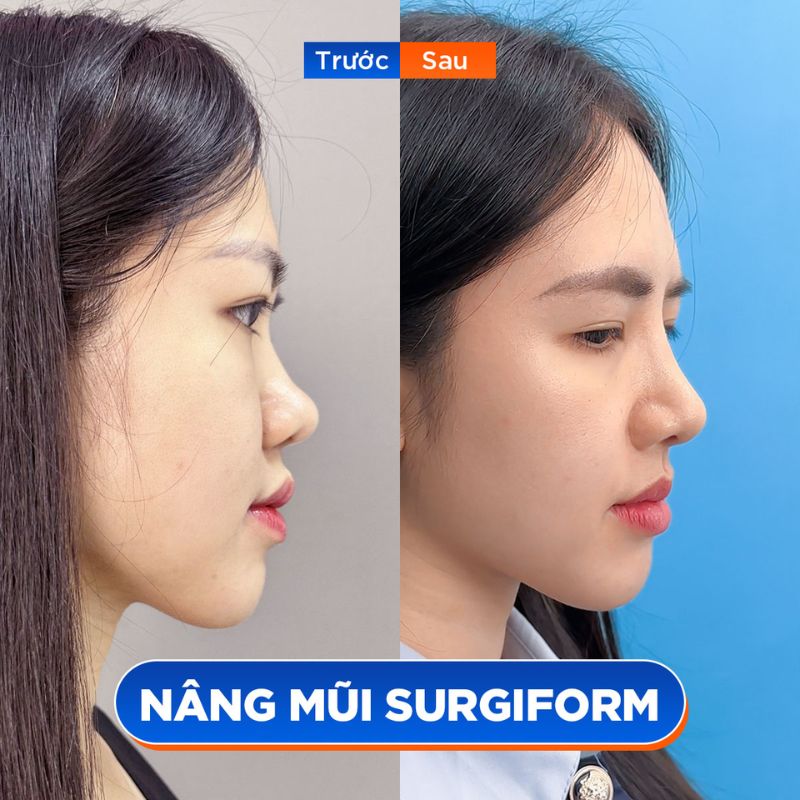 Sụn Surgiform kết hợp sụn tự thân tạo dáng mũi tự nhiên