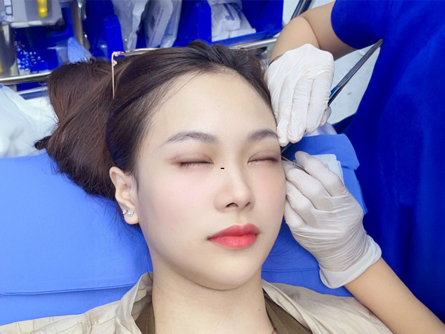 Sau khi cắt chỉ mí mắt khách hàng có thể ăn các loại cá nước ngọt