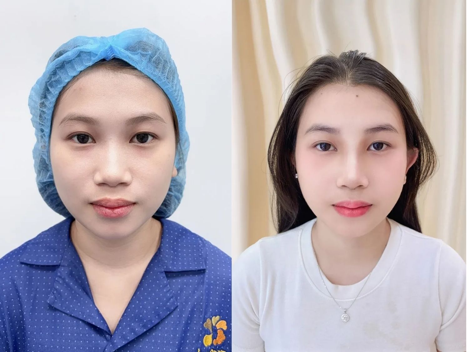 Thu Trang có sống mũi thấp, đầu mũi và cánh mũi hơi bè, sau phẫu thuật dáng mũi đã cao rõ nét, đầu mũi thanh thoát, cánh mũi gọn hơn