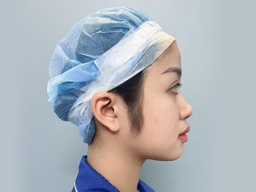 khách hàng mũi tẹt, cánh mũi to, nên cân nhắc nâng mũi cấu trúc
