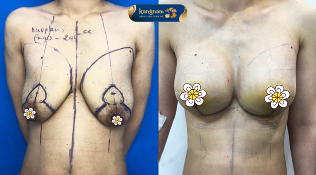 Treo sa trễ tạo bầu ngực tự nhiên, đầy đặn
