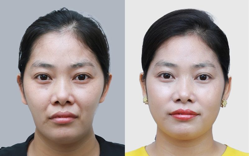 Tiêm filler giúp làm đầy khuôn mặt, giúp gương mặt tươi trẻ, căng bóng hơn