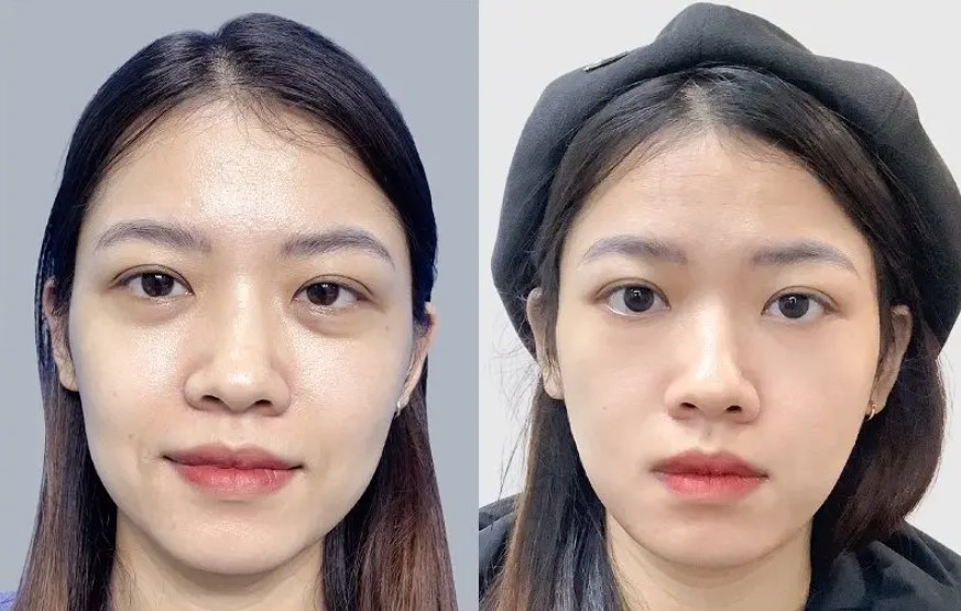 Căng chỉ giúp gương mặt săn chắc, tươi trẻ hơn