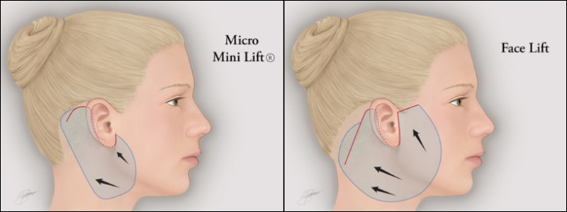 Căng da mặt mini tác động đến 3 khối da để cải thiện tình trạng nếp nhăn, vết chân chim