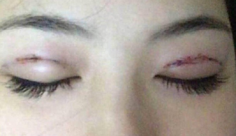 Mí mắt bị sưng tấy quá lâu, có nguy cơ để lại sẹo