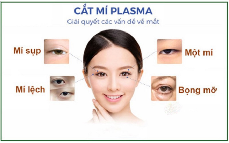 Cắt mí Hàn Quốc Plasma khắc phục tình trạng mí sụp, mí lệch, mí ẩn