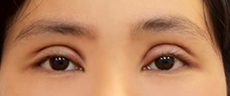 Mí mắt lờ đờ sau khi cắt mí quá sâu