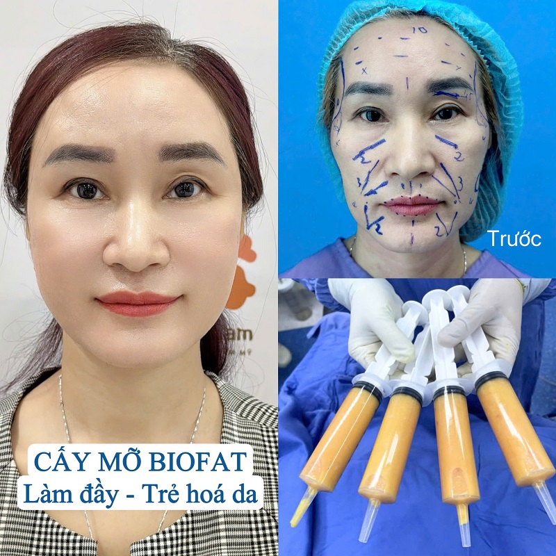 Công nghệ cấy mỡ càng hiện đại sẽ giúp khách hàng sở hữu vẻ đẹp tươi trẻ lâu dài