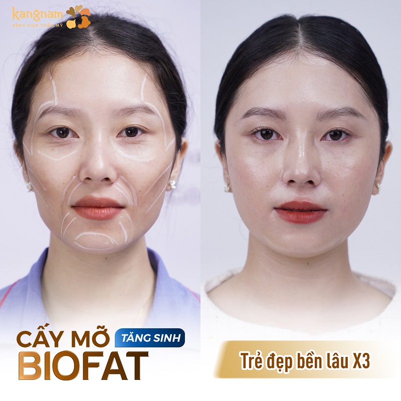 Cấy mỡ BioFat tăng sinh duy trì hiệu quả lâu dài, gấp 3 lần