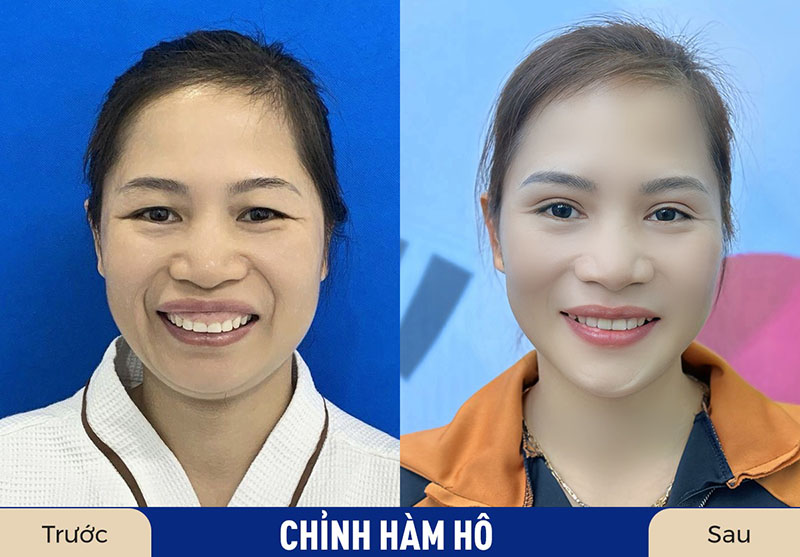 Chỉnh hàm hô nhẹ thường có chi phí thấp hơn so với chỉnh hàm hô nặng