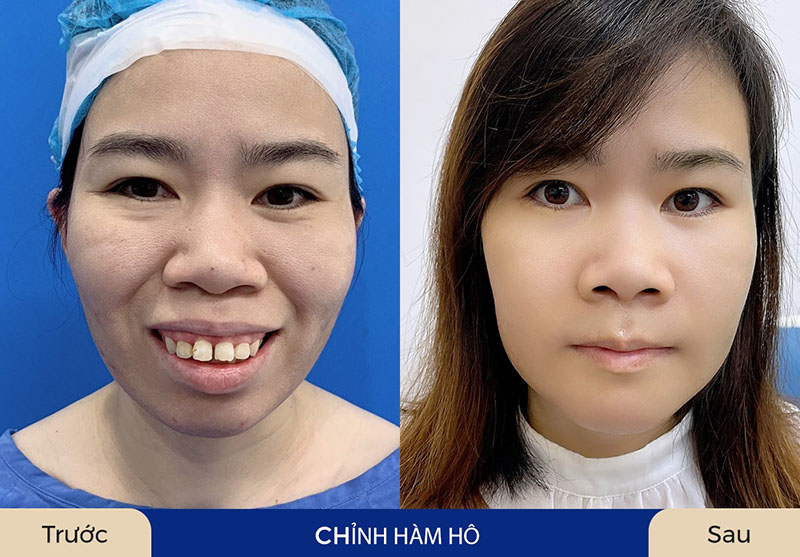 Chi phí chỉnh hàm hô sẽ tùy thuộc vào từng tình trạng