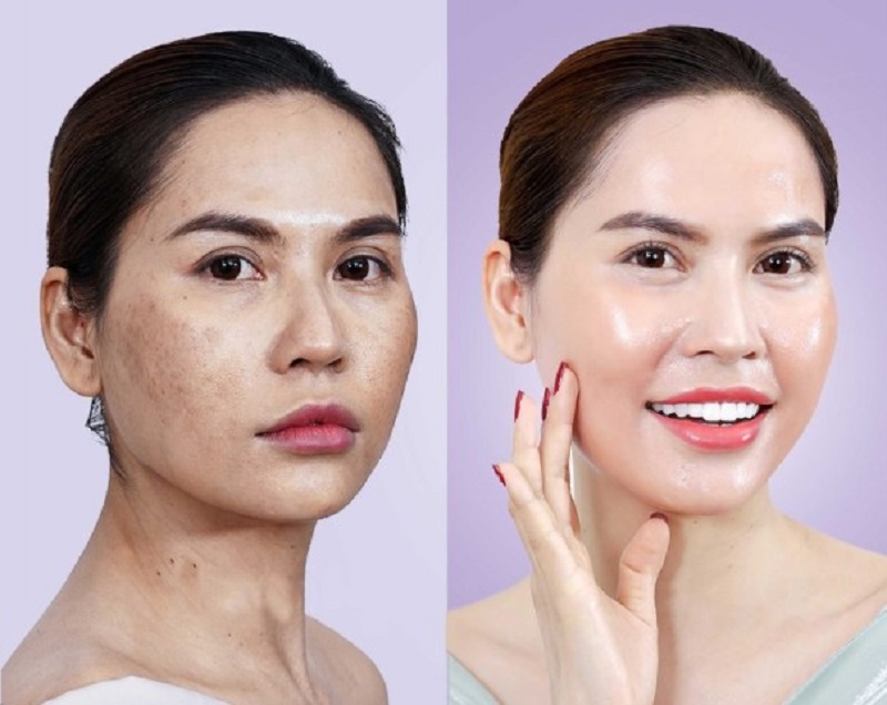 tiêm meso giúp kích thích làn da sản sinh collagen, căng bóng và mịn màng hơn