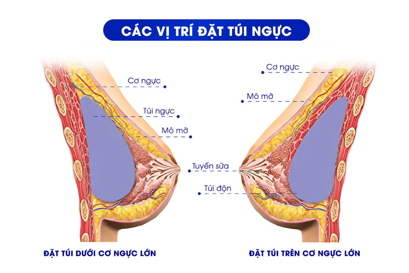 Các vị trí đặt túi ngực phổ biến