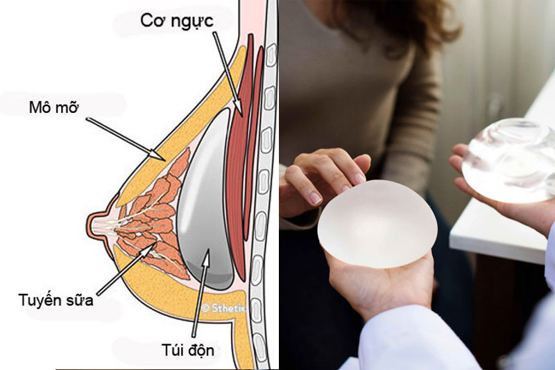 Túi ngực có thể đặt ở trên cơ ngực, dưới cơ ngực hoặc dưới cân cơ ngực