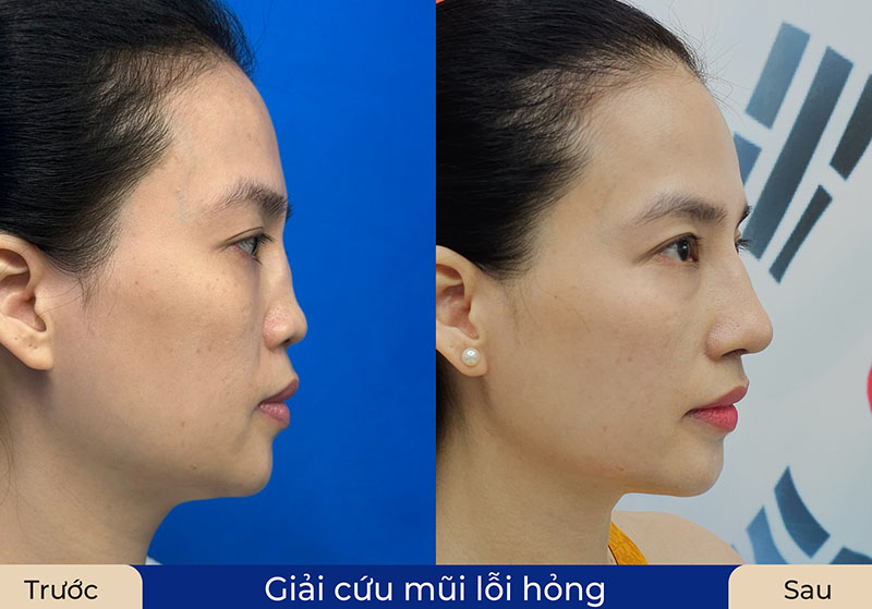 Trường hợp mũi hỏng nặng của Thu Hà được bác sĩ Richard Huy khôi phục toàn diện