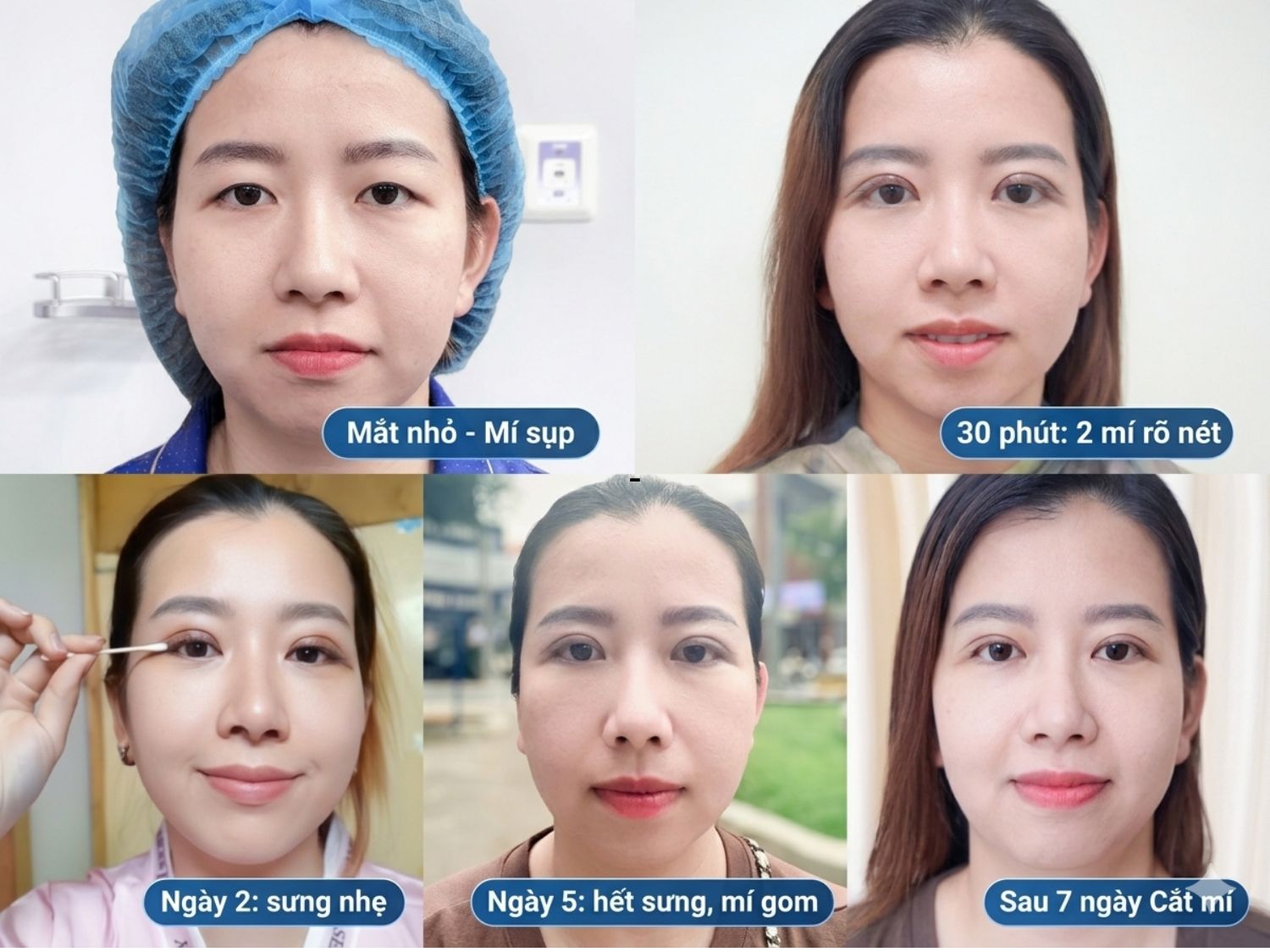 Hình ảnh quá trình phục hồi sau cắt mí 7 ngày của Khách hàng tại Kangnam