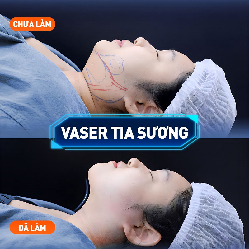 Lựa chọn công nghệ hút mỡ nọng cằm hiện đại