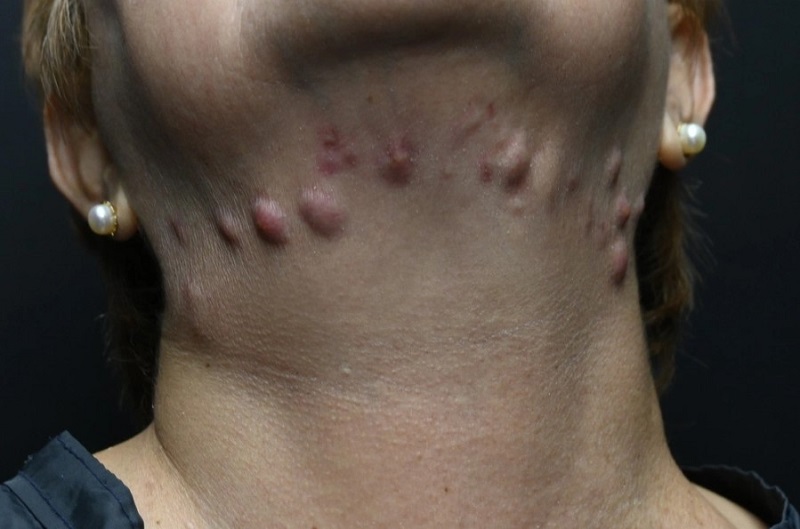 Vùng hút mỡ bị lồi lõm, biến dạng