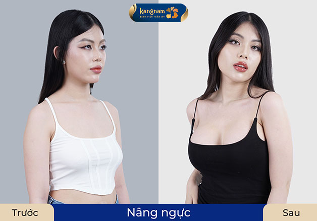 Khách hàng nâng ngực tại Kangnam sở hữu dáng ngực tự nhiên, mềm mại