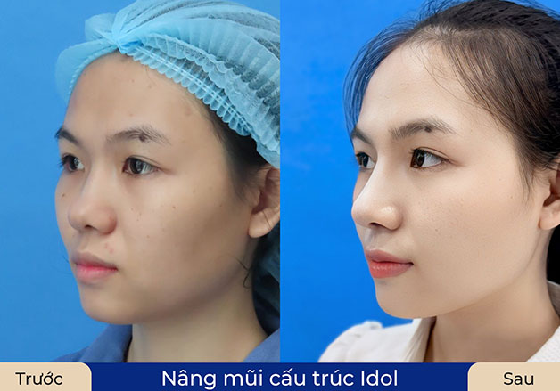 Nâng mũi sau 1 tháng làm tại Bệnh viện Thẩm mỹ Kangnam