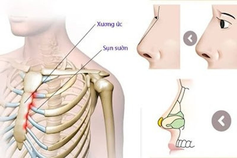 Nâng mũi cấu trúc sụn sườn