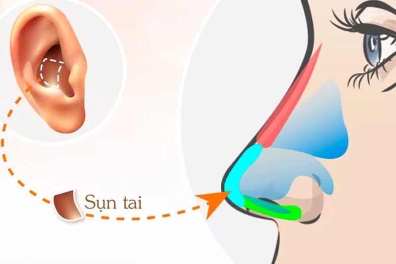 Giá nâng mũi bằng sụn tai phụ thuộc chủ yếu vào phương pháp nâng mũi