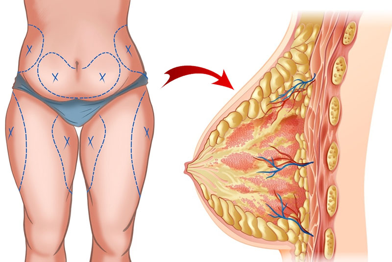 Nâng ngực bằng mỡ tự thân là phương pháp không phẫu thuật