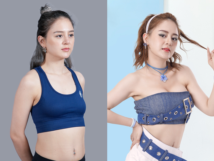 khách hàng ngực lép sau sinh nâng ngực tại Kangnam sở hữu thân hình sexy và tự tin