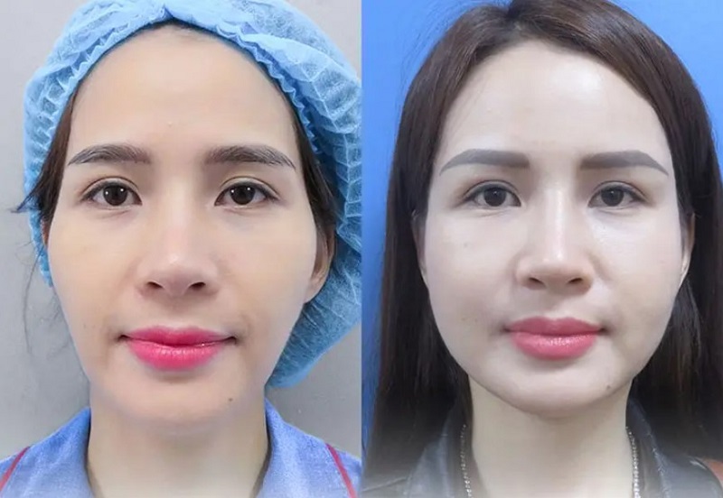 Cấy mỡ tự thân giúp kích thích sản sinh collagen
