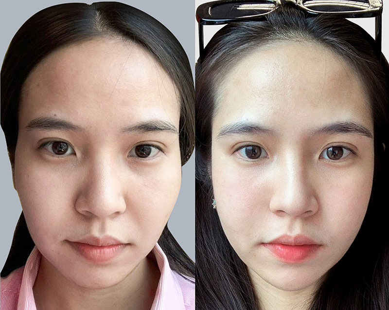 Tiêm filler thái dương giúp làm đầy vùng thái dương hõm lóp, nhưng hiệu quả không duy trì được lâu