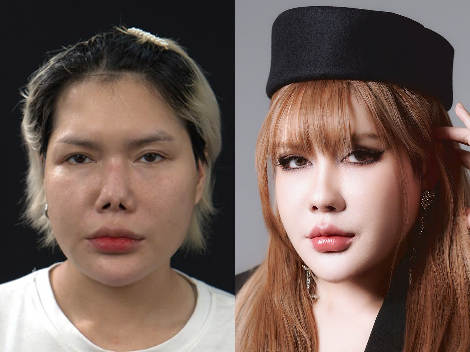 Trần Thị Quỳnh Mai (Hải Phòng) trước và sau khi sửa mũi gãy, co rút , kết quả dáng mũi hoàn thiện cao thon gọn, hài hòa với gương mặt