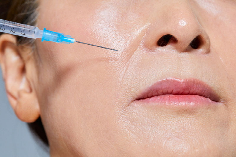 Botox xóa nhăn bắt đầu phát huy tác dụng sau khoảng 3 ngày tiêm