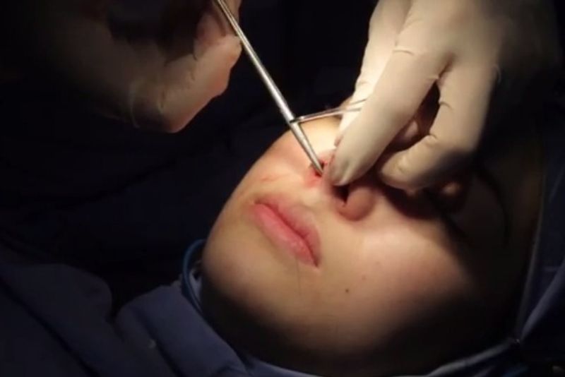 Quá trình tháo sụn mũi