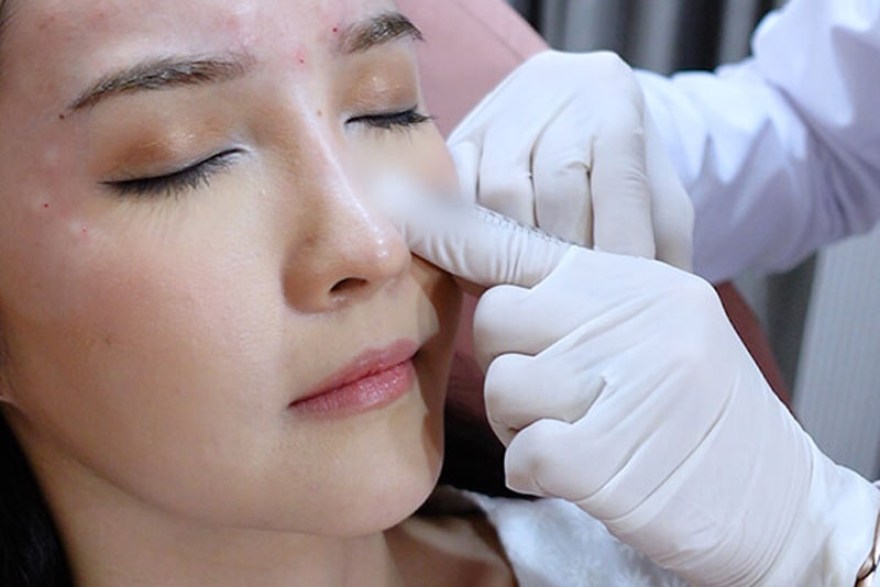 Tiêm botox thường xuyên