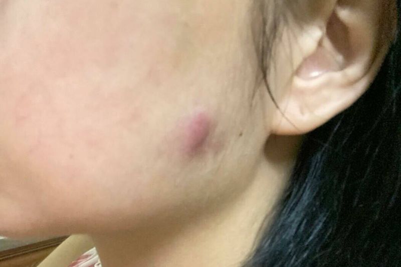 Sưng bầm tại vị trí tiêm botox