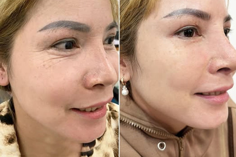 Tiêm botox xóa nhăn