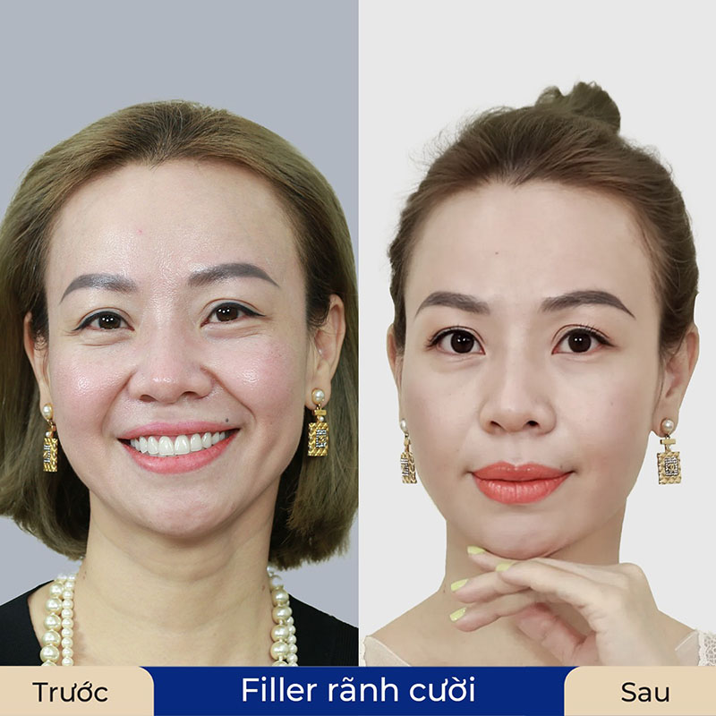 Tiêm filler rãnh cười giúp khách hàng trẻ ra 5 tuổi