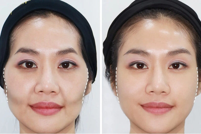 Tiêm filler má hóp giá bao nhiêu tùy thuộc vào loại filler sử dụng