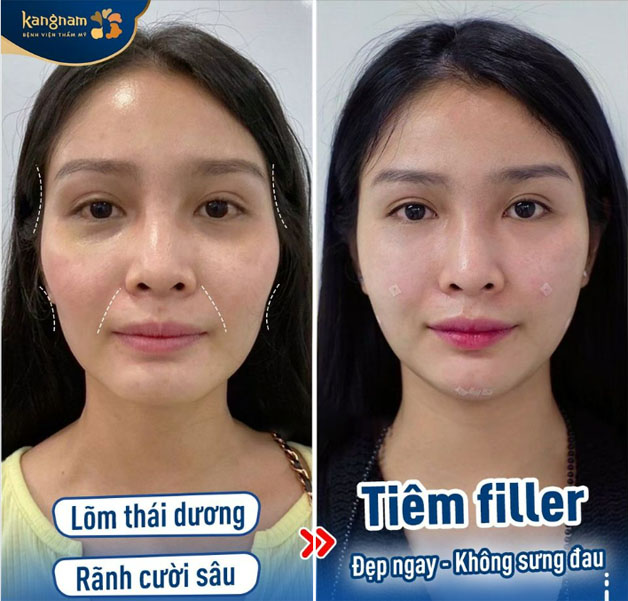 Khách hàng tiêm filler thái dương, rãnh cười sâu, sở hữu gương mặt cân đối