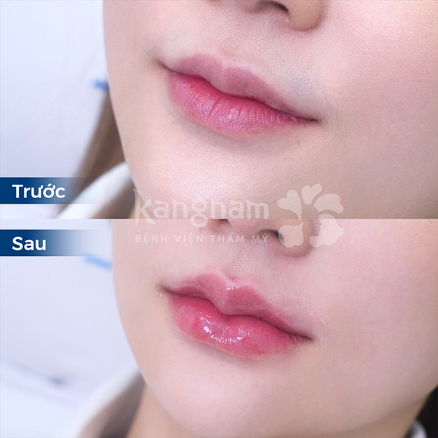 Môi vừa tiêm filler với hiệu ứng căng mọng, viền môi sắc nét hơn