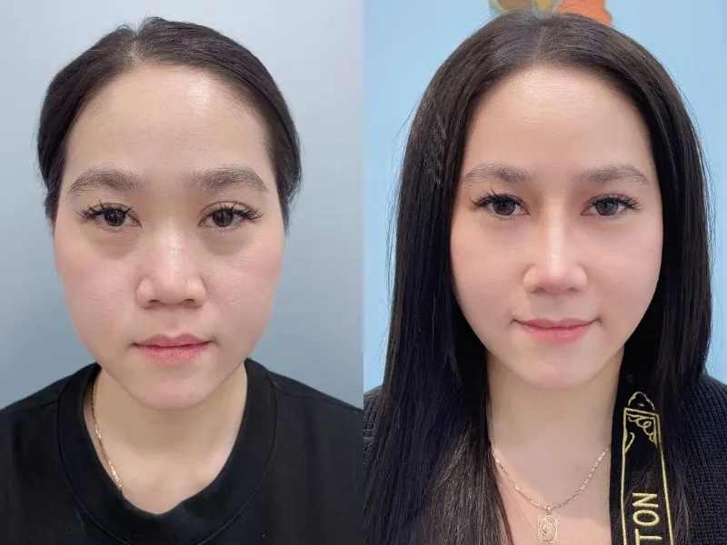 khách hàng Tina Motana Tran trước và sau kh nâng mũi tại Kangnam