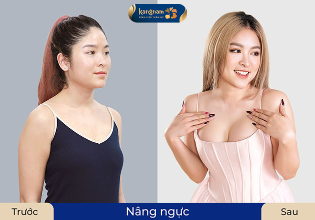 Kết quả nâng ngực tự nhiên, quyến rũ