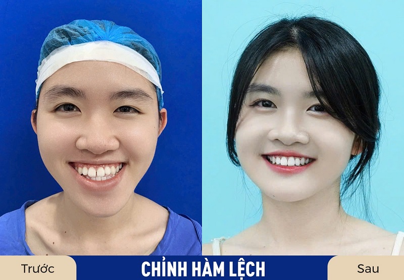 Chi phí phẫu thuật chỉnh hàm tại các địa chỉ thẩm mỹ uy tín