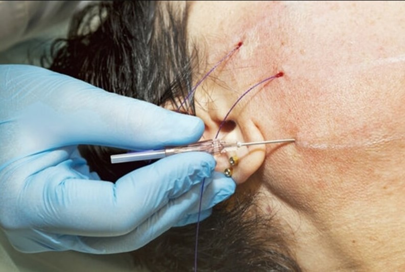 Loại chỉ sử dụng kém chất lượng có thể gây biến chứng cho khách hàng