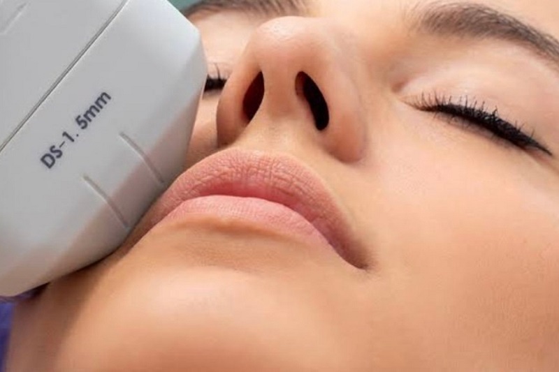 Quá trình căng da mặt Hifu chỉ hơi châm chích nhẹ