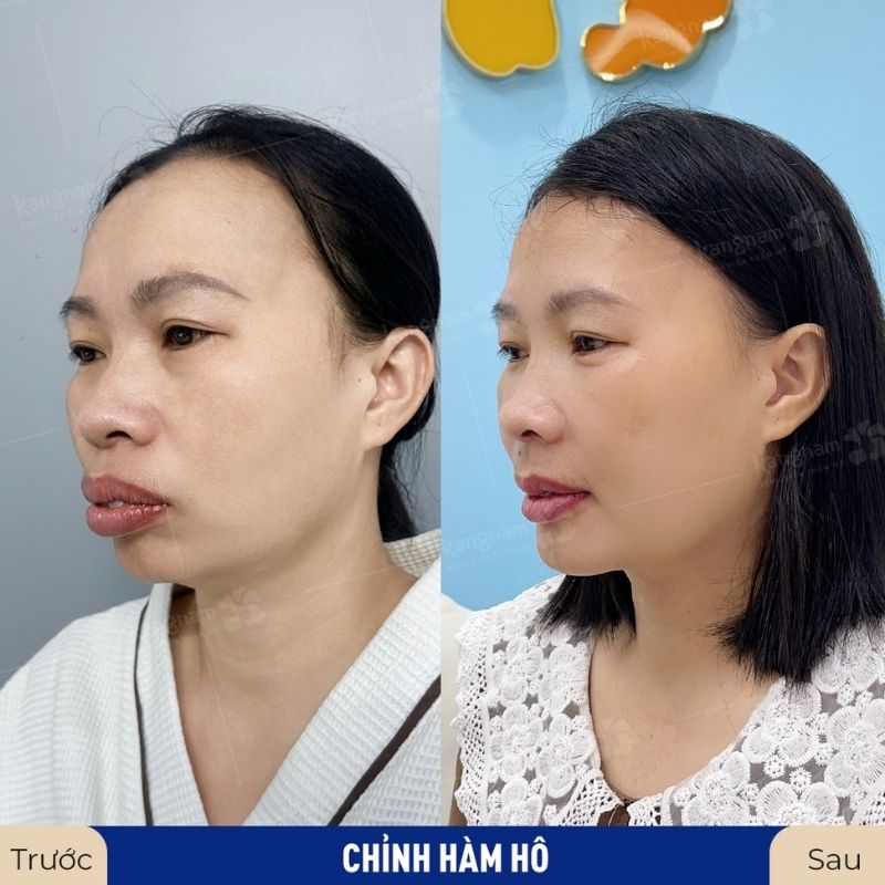 Khuôn hàm cân đối, nâng cao tính thẩm mỹ