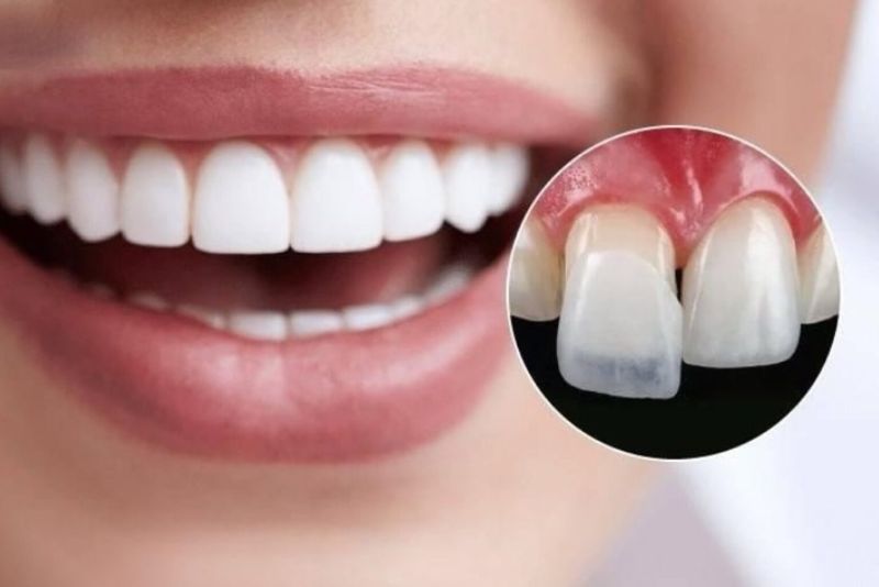 Dán sứ đối với trường hợp răng chìa nhẹ