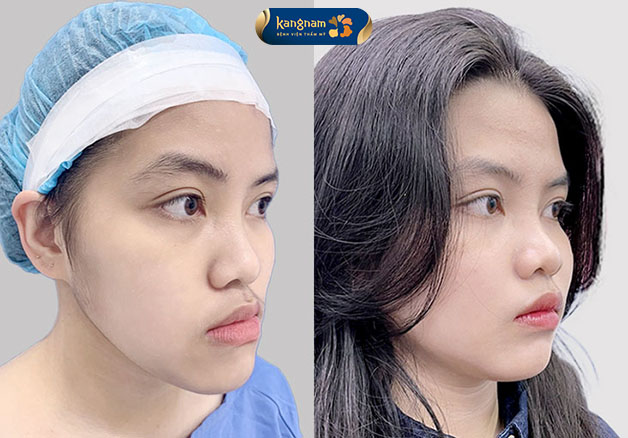 Tình trạng móm ngược trước và sau khi chỉnh sửa