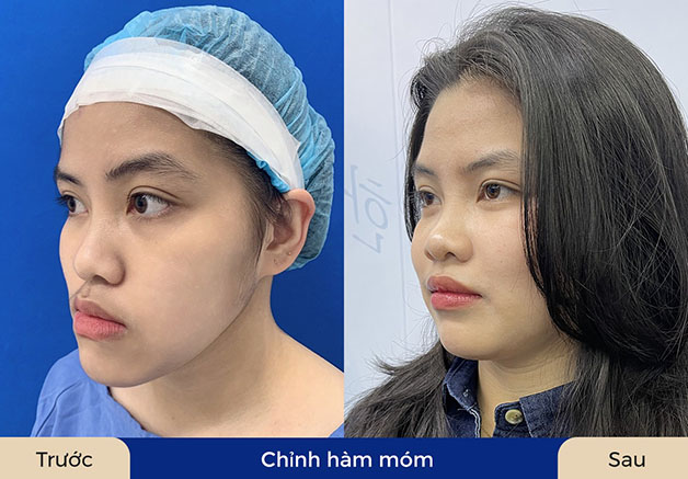Chỉnh hàm giúp gương mặt cân đối, nụ cười đẹp hơn